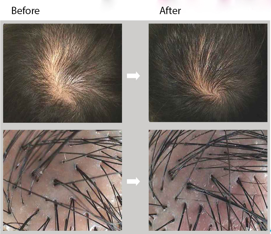  Hair Filler 1ml. is the world's first filler bioreparant for  intensive hair follicle regeneration and hair growth, GAREGEN Co., Ltd  (South Korea) - Art Of Beauty - Art Of Beauty
