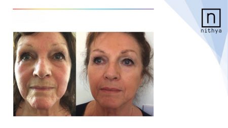 NITHYA Collagen Injections For Face And Body Euroresearch Italy 